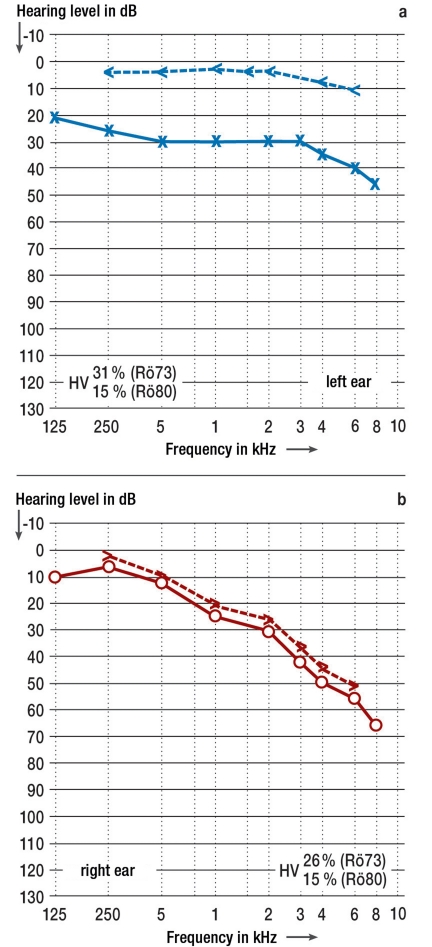 The Impact of Hearing Loss on Quality of Life